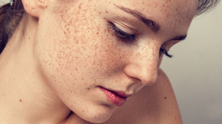 Pigmented Lesions